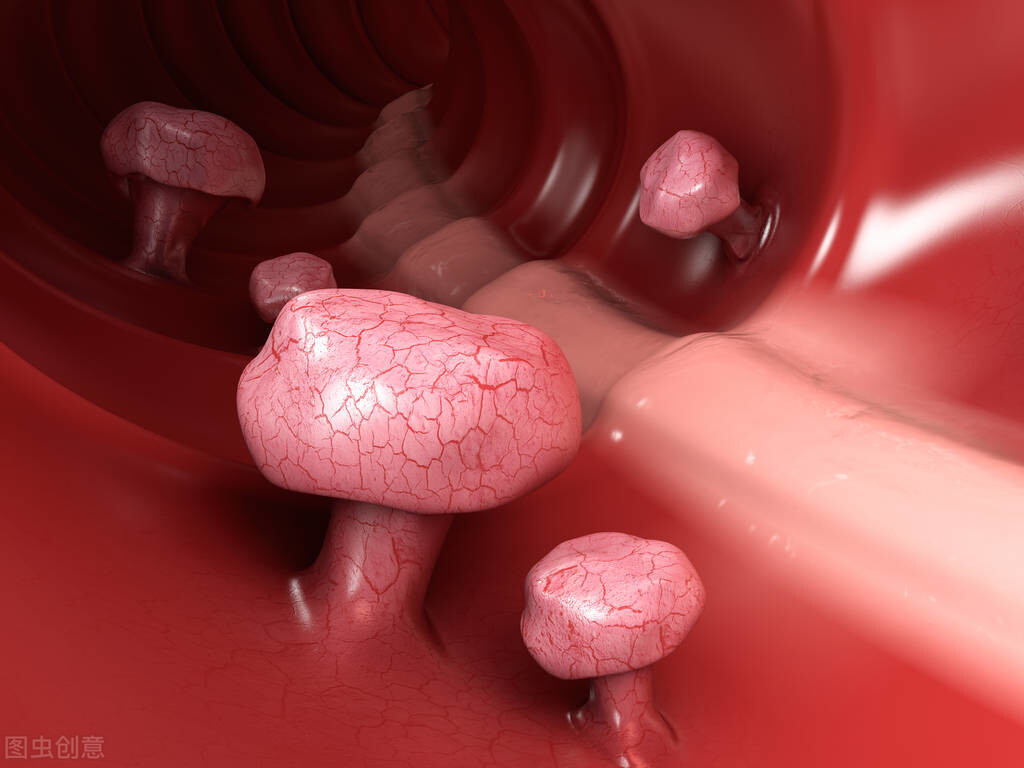 息肉良性居多不用管？这4种息肉赶紧切除，当心出现癌变